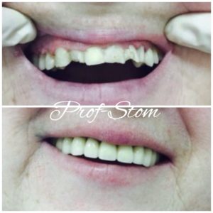 Металлокерамика зубы фото до и после